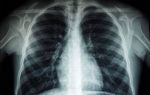 Vakalar patlıyor! Beyaz akciğer sendromu nedir, belirtileri nelerdir?