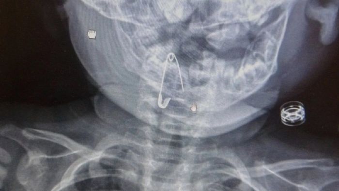 Bitlis`te 8 aylık bebeğin boğazına kaçan çengelli iğne operasyonla çıkartıldı