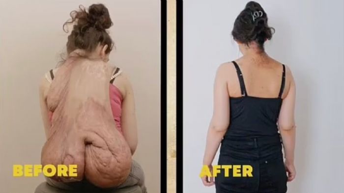 Almanya`da 20 kiloluk tümörle yıllarca yaşadı! Ameliyat hayatını değiştirdi